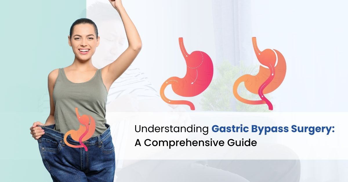 Understanding Gastric Bypass Surgery | A Comprehensive Guide